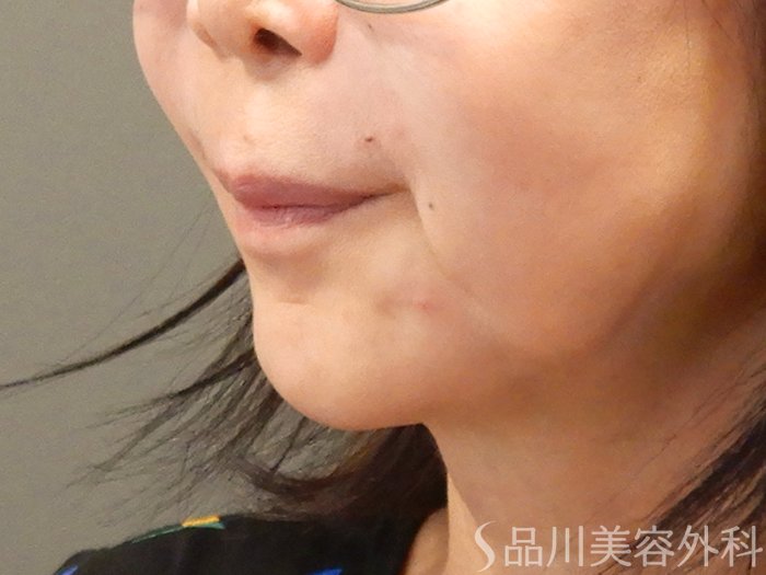 症例NO.71623のAFTER写真
