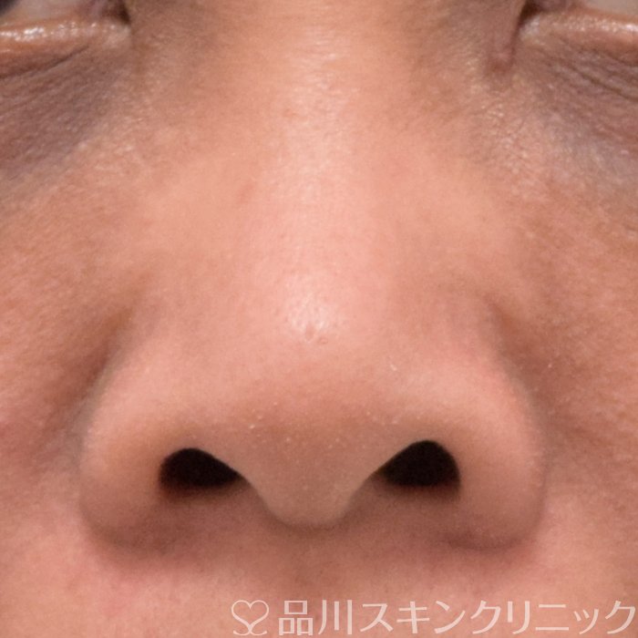 症例NO.70732のBEFORE写真