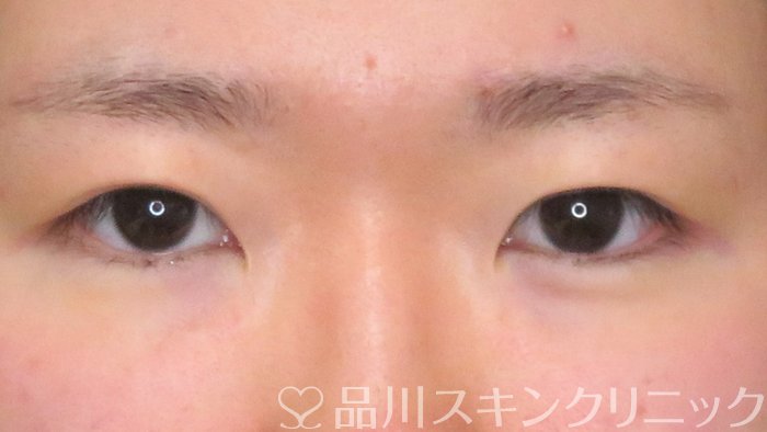 症例NO.63959のBEFORE写真