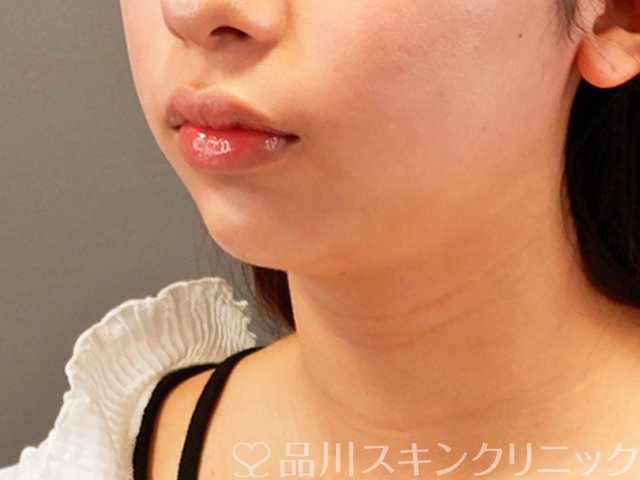 症例NO.70815のAFTER写真
