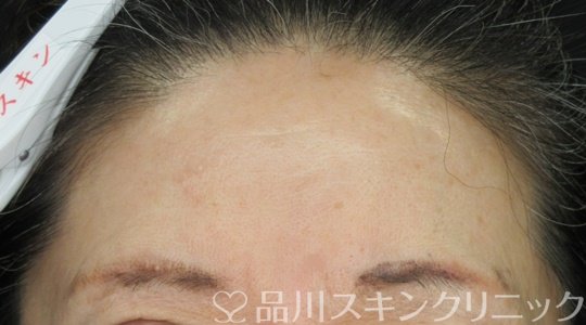症例NO.70484のBEFORE写真