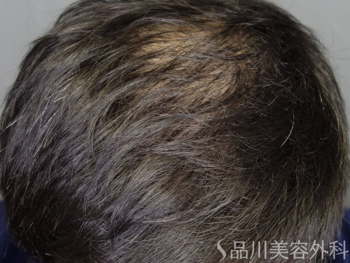 症例NO.72585のAFTER写真