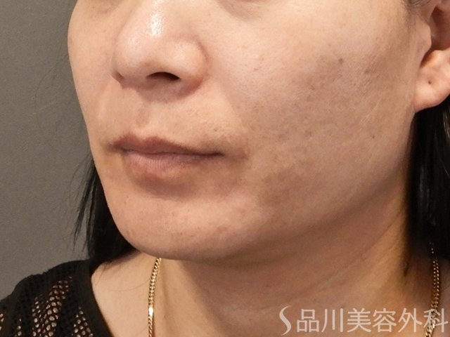 症例NO.75133のBEFORE写真