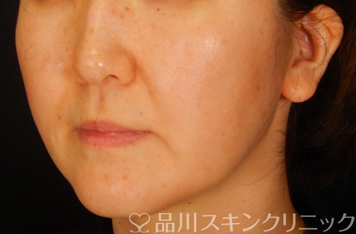 症例NO.65318のBEFORE写真