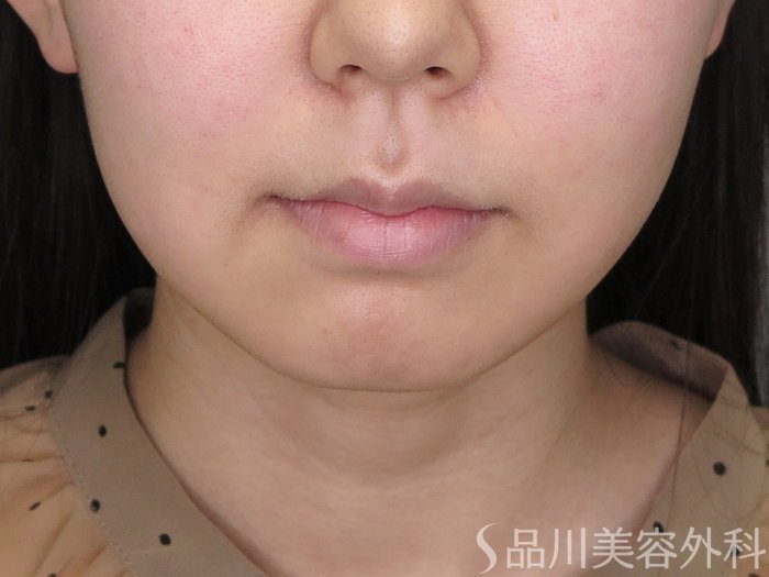 症例NO.71299のBEFORE写真