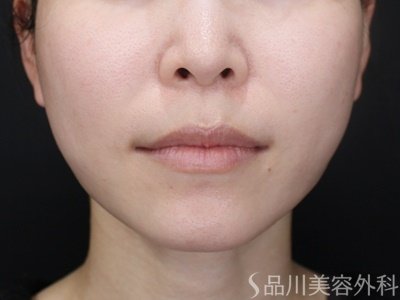 症例NO.72191のAFTER写真