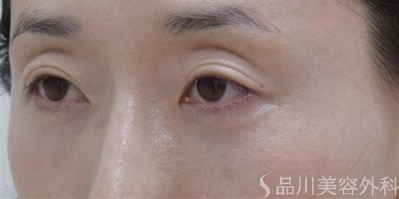 症例NO.61109のAFTER写真