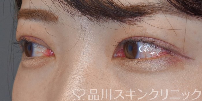 症例NO.72020のAFTER写真