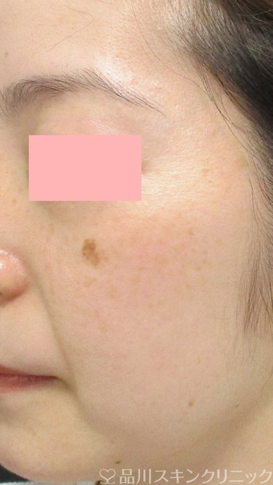 症例NO.69358のBEFORE写真
