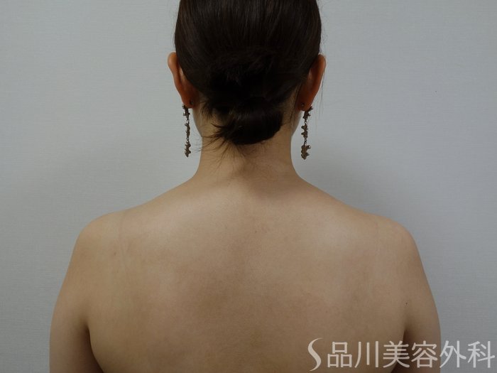 症例NO.73378のBEFORE写真