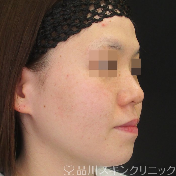 症例NO.74959のBEFORE写真