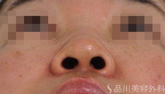 症例NO.36508のBEFORE写真