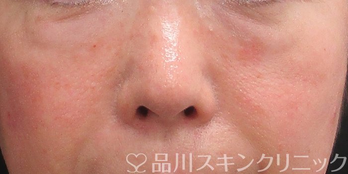 症例NO.73201のAFTER写真