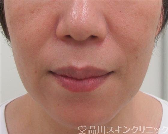 症例NO.31411のBEFORE写真