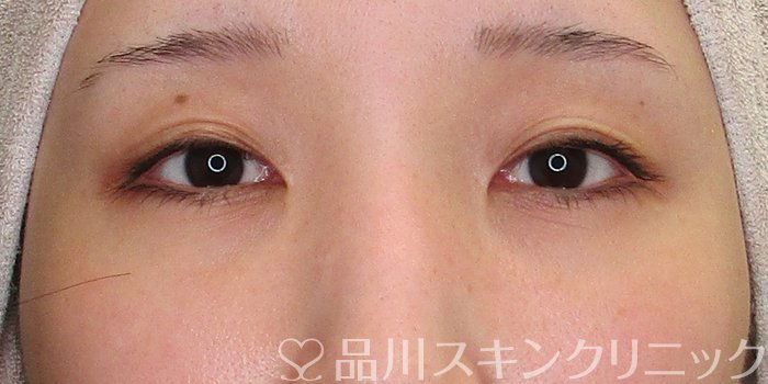症例NO.75270のBEFORE写真