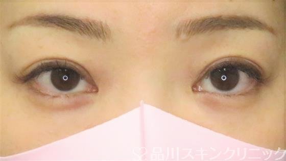 症例NO.61513のAFTER写真
