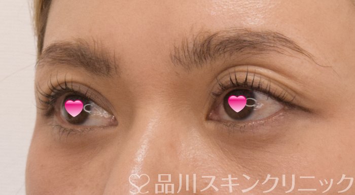 症例NO.74276のAFTER写真