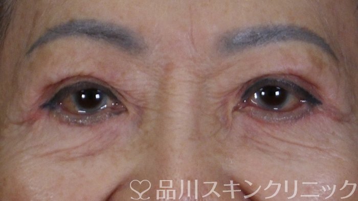 症例NO.68404のAFTER写真