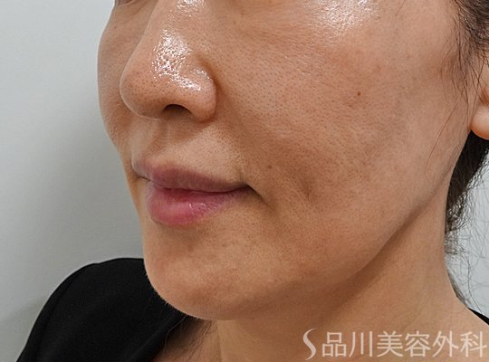 症例NO.62275のBEFORE写真