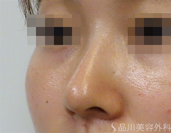 症例NO.36286のAFTER写真