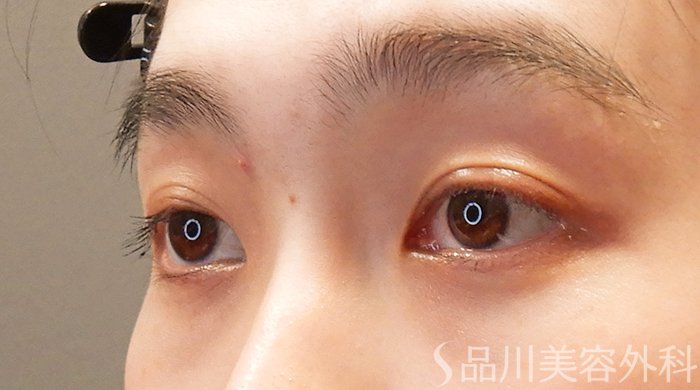 症例NO.69304のAFTER写真