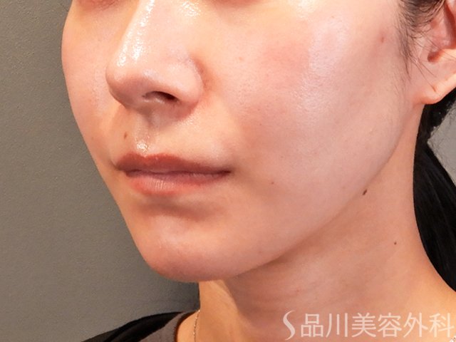 症例NO.70322のBEFORE写真