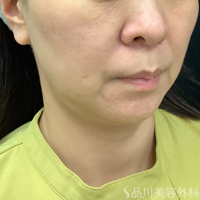 症例NO.75329のBEFORE写真
