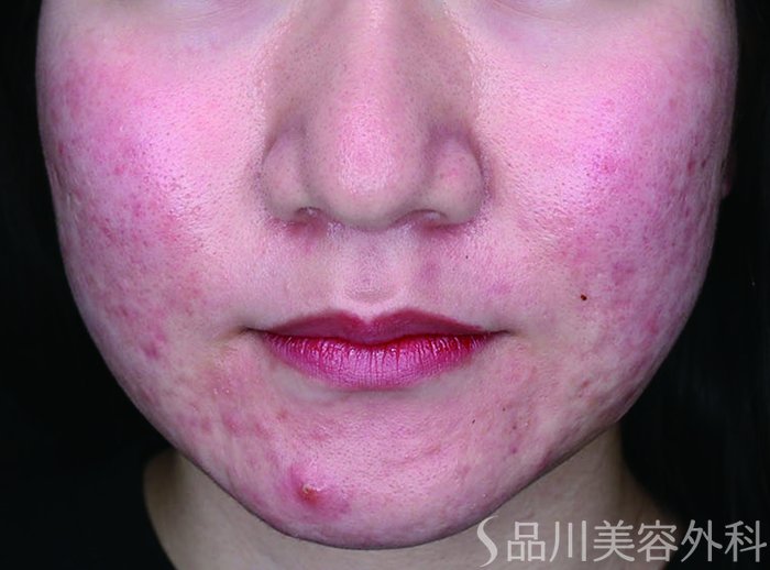 症例NO.73303のBEFORE写真