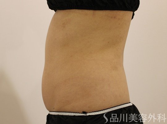 症例NO.74009のBEFORE写真