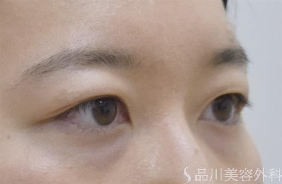 症例NO.54042のBEFORE写真