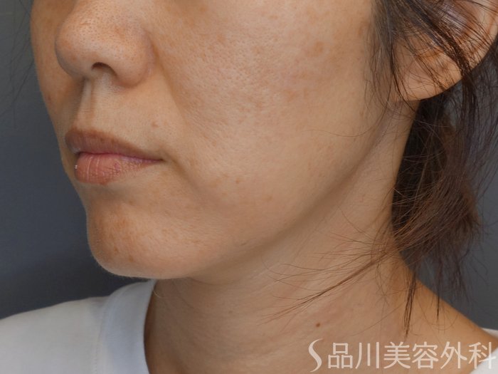 症例NO.71704のBEFORE写真