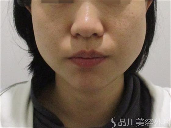 症例NO.45819のBEFORE写真