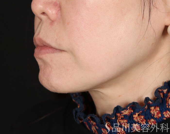 症例NO.73648のBEFORE写真