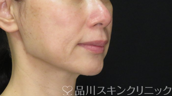 症例NO.72501のBEFORE写真