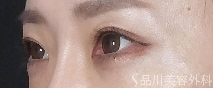症例NO.65934のBEFORE写真