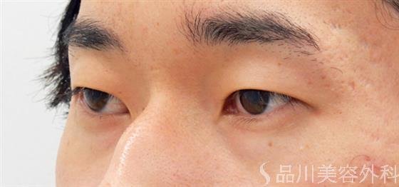 症例NO.53857のBEFORE写真