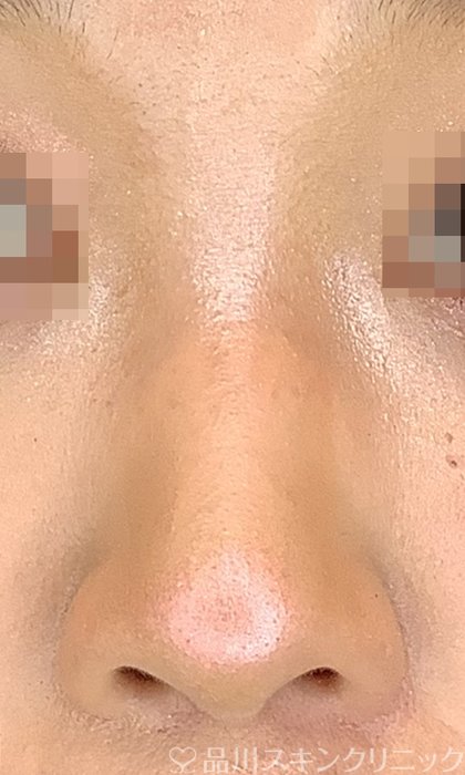 症例NO.72796のBEFORE写真