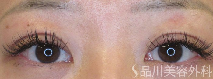 症例NO.70615のAFTER写真