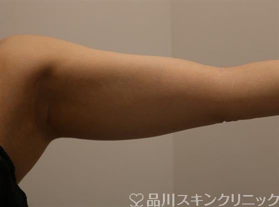 症例NO.46039のBEFORE写真