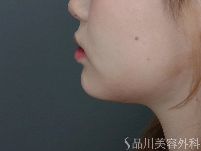 症例NO.71716のAFTER写真
