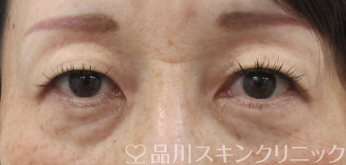 症例NO.67814のBEFORE写真