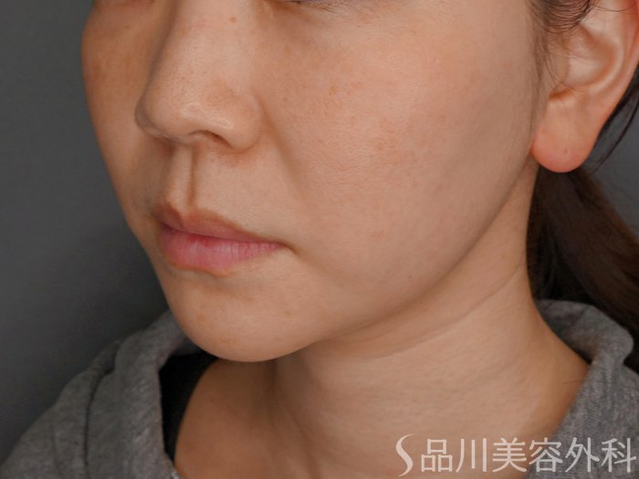 症例NO.74329のBEFORE写真