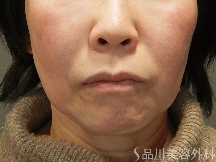 症例NO.69536のBEFORE写真