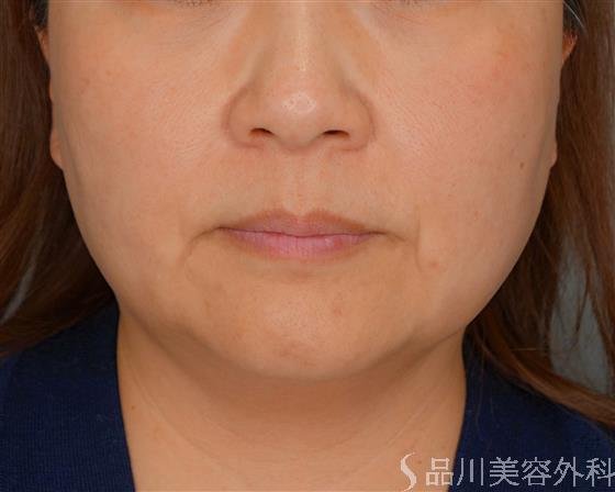 症例NO.53519のBEFORE写真