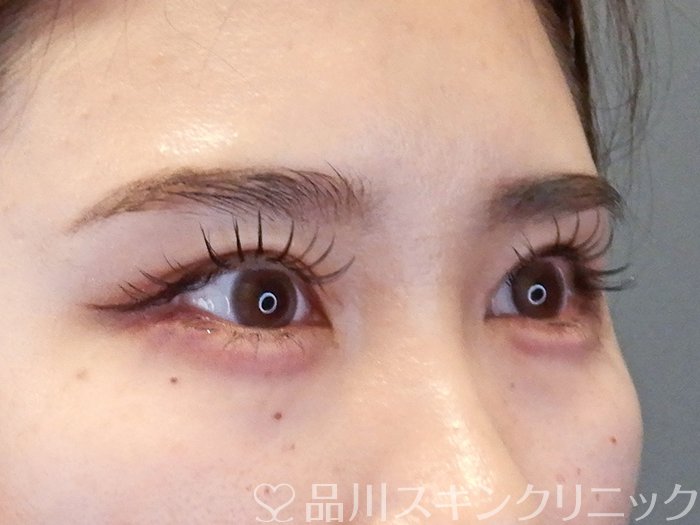 症例NO.65349のAFTER写真