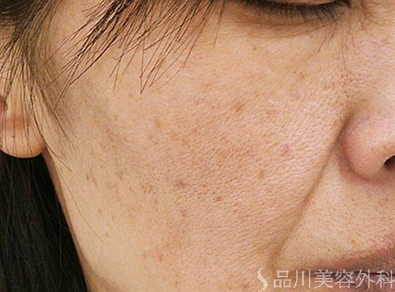 症例NO.23671のAFTER写真