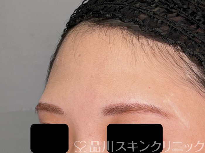 症例NO.70001のBEFORE写真