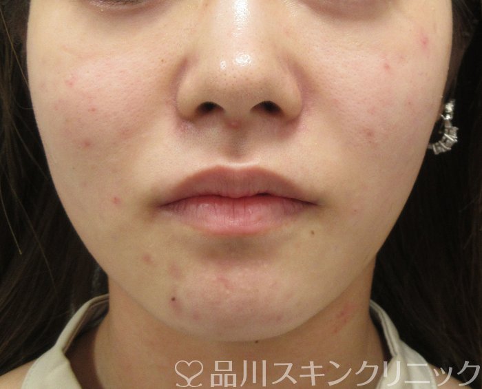 症例NO.74762のAFTER写真
