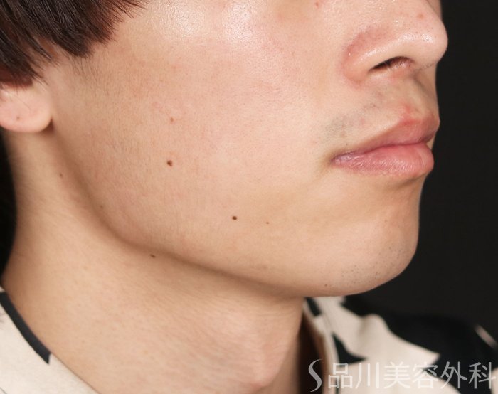 症例NO.73766のBEFORE写真