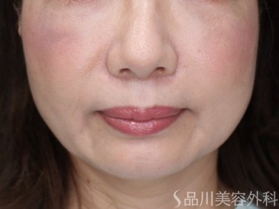 症例NO.71370のAFTER写真